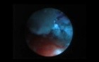 Staghorn Kidney Stone - PCNL