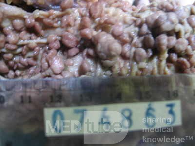 Synchronous Cancers, Familial Adenomatous Polyposis (30 of 36)