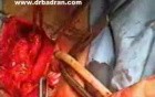 Bulbocavernosus Flap For Vesicovaginal Fistula