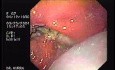 Partial Dehiscence of Suturing with Gastro-cutaneous Fistula (2 of 4)
