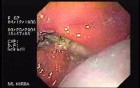 Partial Dehiscence of Suturing with Gastro-cutaneous Fistula (2 of 4)