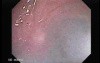 Rectal Stalked Polyp (4 of 7)