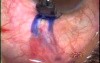 Trabeculectomy complications treatment - treatment of tenon cyst with use of Fugo Blade