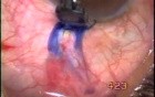 Trabeculectomy complications treatment - treatment of tenon cyst with use of Fugo Blade