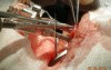 Vasectomy - Reversal - Infertility Treatment