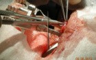 Vasectomy - Reversal - Infertility Treatment