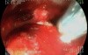 Duodenal papila tumor- endoscopic treatment