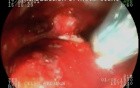 Duodenal papila tumor- endoscopic treatment