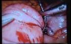 Jejunal Gastrointestinal Stromal tumor (GIST) (77 of 86)