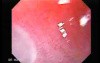 Barrett Esophagus - endoscopic view  (3 of 9)
