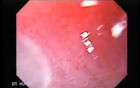 Barrett Esophagus - endoscopic view  (3 of 9)