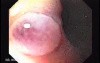 Longstanding gastroesophageal reflux disease (3 of 7)