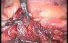 Laparoscopic Appendectomy