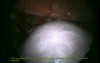 Total Laparoscopic Hysterectomy