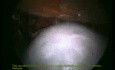 Total Laparoscopic Hysterectomy