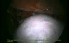 Total Laparoscopic Hysterectomy