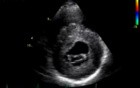 Hypertrophic Cardiomyopathy