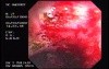 Radiation Proctosigmoiditis (14 of 14)
