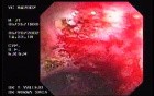 Radiation Proctosigmoiditis (14 of 14)