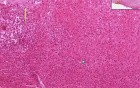 Ulcer, amputation stump - Histopathology - Skin