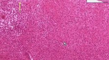 Ulcer, amputation stump - Histopathology - Skin