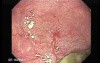Zenker's Diverticulum - 75 Years-Old Male