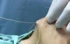 Chin augmentation - Serdev Suture