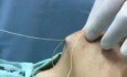 Chin augmentation - Serdev Suture