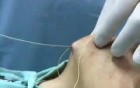 Chin augmentation - Serdev Suture