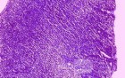 Gastric Lymphoma (7 of 10)
