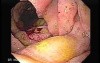 Gastroduodenal MALT lymphoma (9 of 9)
