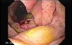 Gastroduodenal MALT lymphoma (9 of 9)