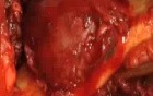 Ameloblastoma