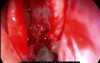 Concha Bullosa Resection