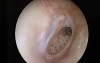 Large Center Eardrum Perforation