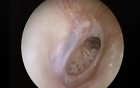 Large Center Eardrum Perforation