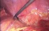 Laparoscopic Left Hemicolectomy Due To Colon tumor