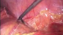 Laparoscopic Left Hemicolectomy Due To Colon tumor
