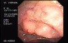 Tubulo - Villous Adenoma - Endoscopy (3 of 28)