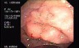 Tubulo - Villous Adenoma - Endoscopy (3 of 28)