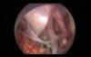 Endoscope Inside The Brain 
