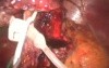 Revision Bariatrics: Band to Sleeve - SILS 