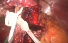 Revision Bariatrics: Band to Sleeve - SILS 