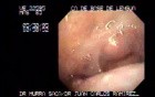 Carcinoma of the Base if the Tongue