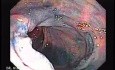 Colonic Tuberculosis Mimicking Crohn's Disease (7 of 12)