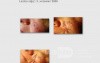 Basal-Cell Carcinoma
