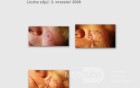 Basal-Cell Carcinoma