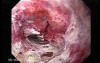 Adenocarcinoma of the Gastroesophageal Junction - Esophagus-Hernia Fistula, Part 2