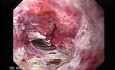 Adenocarcinoma of the Gastroesophageal Junction - Esophagus-Hernia Fistula, Part 2