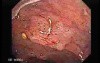 Familial Adenomatous Polyposis (19 of 36)